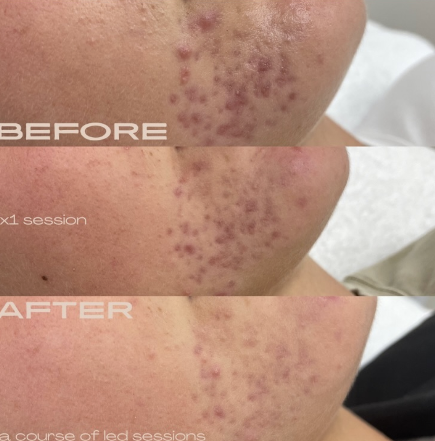 Client skin results before and after treatment at The Skin Bar and Lounge