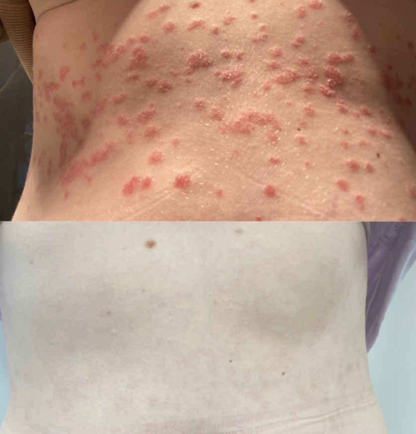 Client skin results before and after treatment at The Skin Bar and Lounge