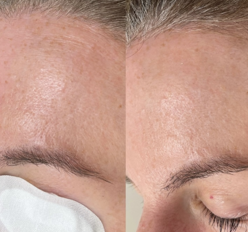 Client skin results before and after treatment at The Skin Bar and Lounge